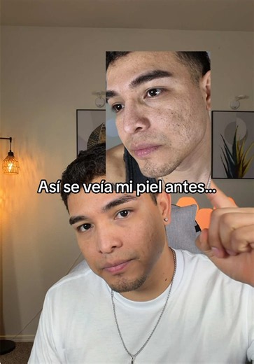 Respuesta a @Vale tiktokshop No fue de un día para otro, pero siendo constante sí he notado cambios en la apariencia de mi piel. Esta crema ya es parte de mi rutina diaria. #dralthea345 #koreanskincare #acnescars