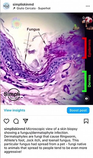 Microscopic view of a skin biopsy showing a fungus/dermatophyte infection. Dermatophytes are fungi that cause Ringworm, Athlete’s foot, Jock itch, and toenail fungus. This particular fungus had spread from a pet - fungi native to animals that spread to people tend to be even more aggressive! #fungus #fungi #infection #nature #natural #animal #pet #spread #skin #skincare #skinexpert #med #medicine #doctor #dr #physician #micro #microscopy #microscope #histology #bio #biology #derm #dermatology #d