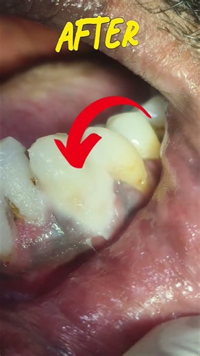 Painful Cervical Abrasion? Filling Done! 😱➡️😁#shorts #youtubeshorts #dental #dentistry #dentalclinic