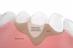 Flap Surgery & Gum Surgery in Hyderabad, India at FMS DENTAL