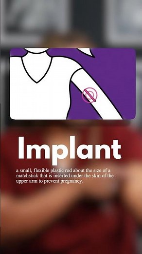 How the Contraceptive Implant Works (Simple Guide)