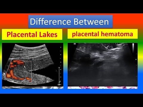 Distinction between Placental Lakes and placental hematoma