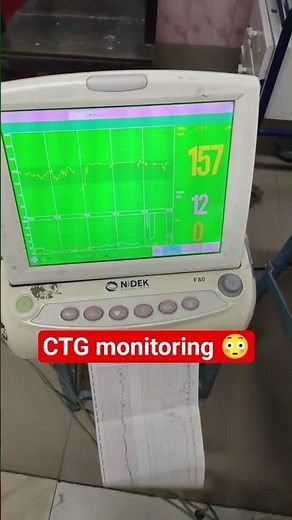 CTG monitoring Cardiotocography fetal heart sound #hospital #medical #life #doctor #ctg #viral ziaul