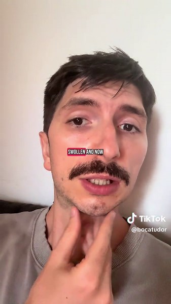 Wisdom Teeth Removal Surgery in NYC: What to Expect