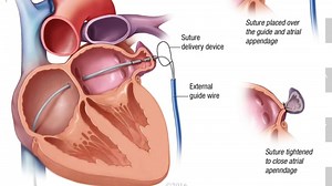 Leaks after percutaneous left atrial appendage occlusion and stroke risk - Mayo Clinic