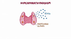 Video: Hyperparathyroidism: Clinical sciences - Video Explanation! | Osmosis | Osmosis