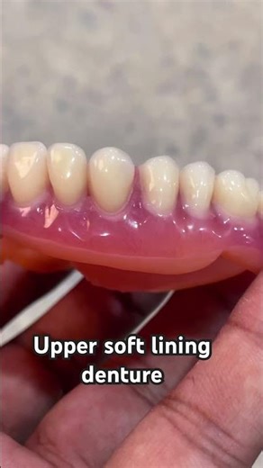 Upper soft lining denture 😬😬😬#dentist #apexdental #splittooth #orthodontist #partialdenture