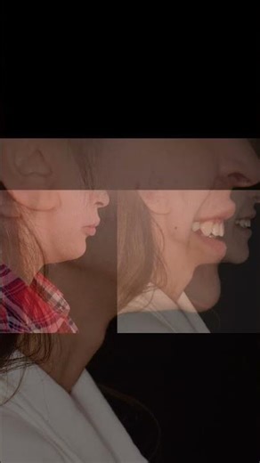 #orthognathicsurgery #facialaesthetics #mandibularadvancement #maxillofacialsurgery #omfs