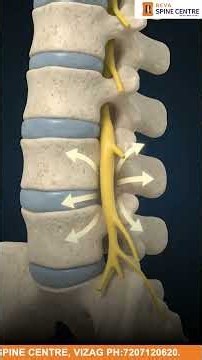 ⚠️ Don’t Ignore Leg Weakness Even If There’s No Pain – Spine Specialist Warns 🦵😣 #legweakness #yt