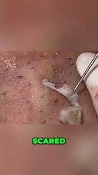 Gross Sebum String Extraction From Skin! #shorts