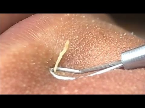 Satisfying Videos | Pimples Popping - Blackheads - Acne & Cysts | Compilation 120
