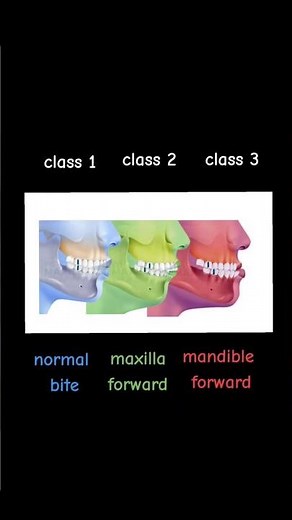 Angle’s Classification of Malocclusion 🦷✨️ #dentistry #dentist #dental_student #dental #طب_الاسنان