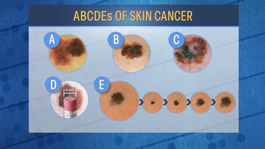How to identify skin cancer through self-exams