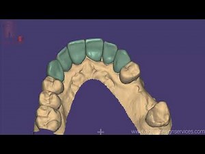 Exocad : Designing Post and Core for a Dental Laboratory