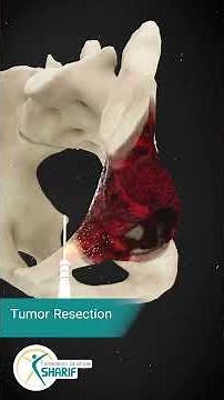 Bone Ingrowth in Pelvic Reconstruction Following Ewing Sarcoma Resection