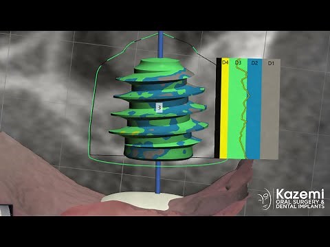 Dental Implant Placement and Sinus Lift Bone Graft Using Internal Osseodensification Technique