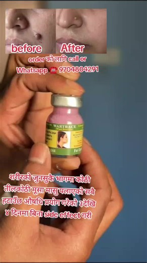 free home delivery all over Nepal call Whatsapp ☎️ 9704804291 #तिलकोटी #मुसा_हटाउने #SkinCareNepal #HerbalProduct #BeforeAfter