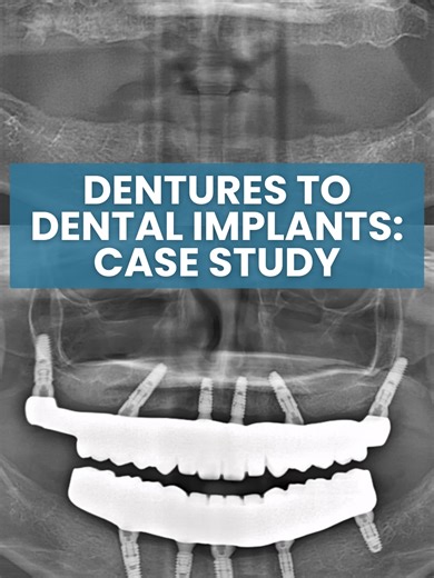 Ever wonder what really goes into a full mouth dental implant transformation? Dr. McRee breaks down @Kate | Denture Dame 🦷 ‘s All-On-X journey – walking you through the strategy and key steps behind creating Kate’s dream smile. Watch the full video at the link in our bio to learn more! Schedule your free consultation by calling 904-506-1233 or by visiting the link in our bio. #dentalimplants #JAXImplants #AllOn #SmileMakeover #SmileTransformation