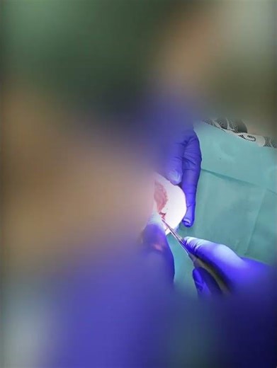 Mandibular Wisdom Tooth Extraction/Removal ‪@DentistPOV‬