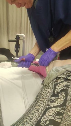 frist cast removal ever