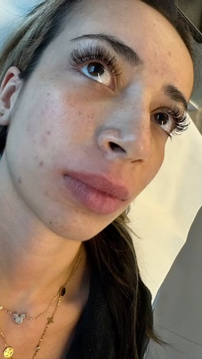 This client travelled 3 hours to have her lips dissolved due to her being unhappy with the migration and shape of her lips from another practitioner we dissolved the area and refilled 10 days after treatment 💉🔥 . Before & After we added 1.1ml @lumifil_uk Kiss using a 30g needle to create more definition 🔥🥰 . Swelling is present and will subside around 4/5 days after treatment this client was lucky enough to receive no bruising. Please be aware when using a 30g needle in general and especiall