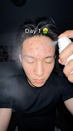 20 Days Acne Spray 🤷🏻‍♂️