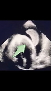 153K views · 561 reactions | Diagnosis? 廊 We really need your help on this one, what is forming in the pericardial sac? 﫵 Preparing for echo board exams? We have 1,200 practice questions and mock tests for you over on our website to help you study ️ #echocardiography #echocardiogram www.theechojournal.net/choose-your-plan | The Echo Journal | Facebook