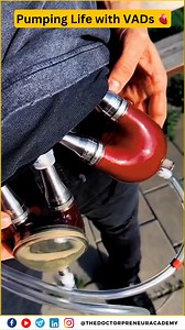 1.4M views · 1.5K reactions | The artificial heart, also called a...