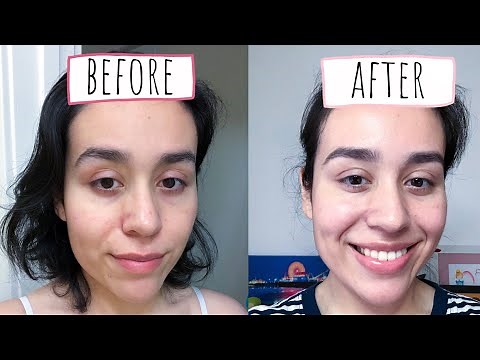 How I Deal With My Seborrheic Dermatitis