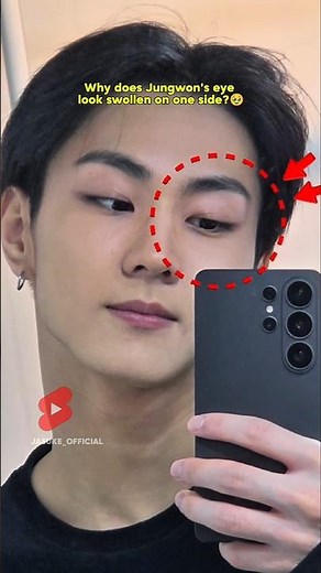 Why does Jungwon's eye look swollen on one side?🥺#enhypen #jungwon