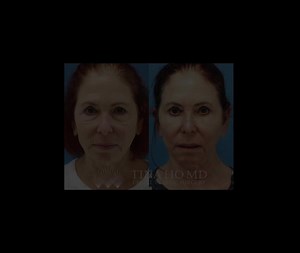 Brow Lift and Blepharoplasty: Before and After