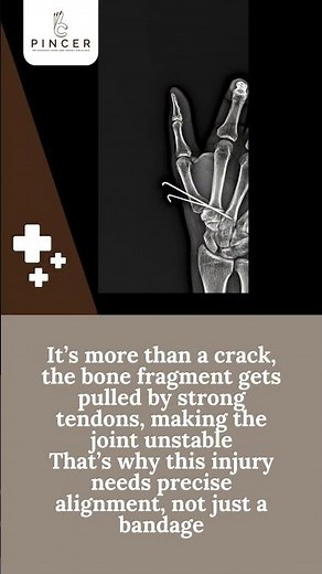 A simple fall… and you can’t hold your phone — it could be a Bennett’s Fracture.
