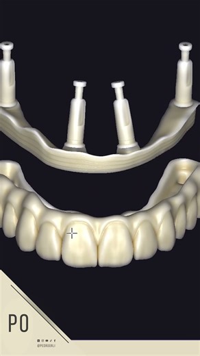Ibar #exocad #dentalcaddesign #cadcam #dentist #dental