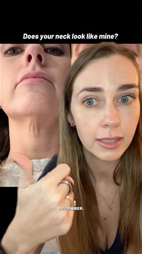 I Got Neck Liposuction & Renuvion | Full Recovery + Results