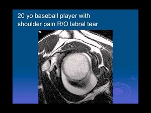 Shoulder Instability | Pt. 1