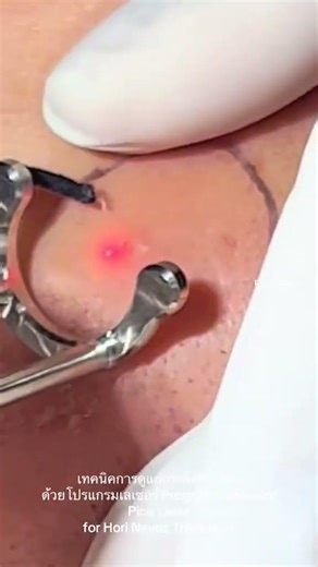 Treatment technique for deep freckles/picolasma using the Discovery Pico Laser program. #freckles...