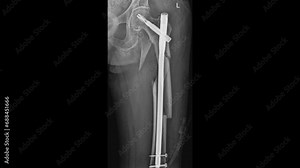 femur Fracture with Intramedullary Nail
