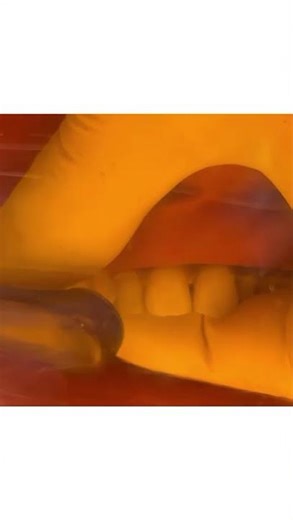 IVENEER "cut wings" spoon technique with Kuraray injectable composite