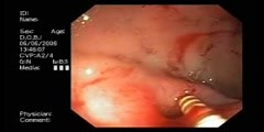 BLEEDING ULCER IN DUODENUM