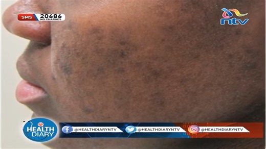 2.7K views · 111 reactions | Hyperpigmentation is a common condition that makes some areas of the skin darker than others, it occurs when the skin produces excess melanin. #HealthDiaryNTV now airing | NTV Kenya | Facebook