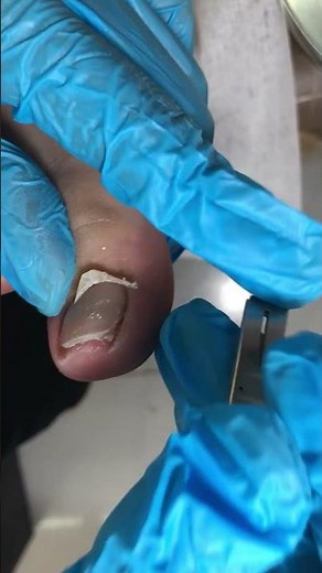 Amazing Toenail Trimming... #pedicure #toenails