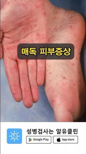 매독 걸리면 나타나는 피부 증상?! #데이트 #매독 #남친 #성병 #에이즈 #헤르페스