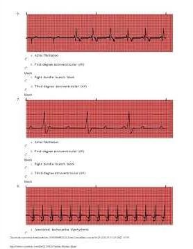 Relias Dysrhythmia Basic A Test Actual Exam Questions Answers For 2024 2025