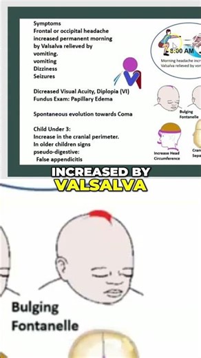 Intracranial Hypertension Headache Alert: Symptoms, Causes, and Relief #shorts