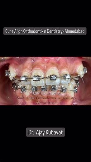 Prof. Dr. Ajay Kubavat on Instagram: "Predictable Canine Movement | 3-Month Progress see the transformation! At Sure Align Orthodontix n Dentistry, Dr. Ajay Kubavat’s latest case demonstrates how passive self-ligation paired with a custom 0.016” special plus Australian archwire and strategic stops enables targeted, predictable canine movement—without shifting premolars or lateral incisors. 🔬 Technique Highlights • Passive self-ligating brackets to lower friction and control force • Custom archw