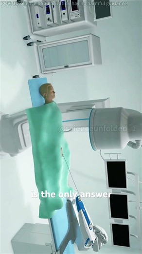 Prostate Artery Embolization (PAE) 3D Animation#prostat #artery #embolization #shrink #supply