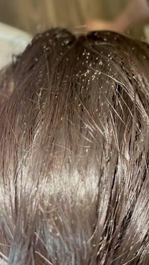 Effective Lice Removal for Kids: A Parent's Guide