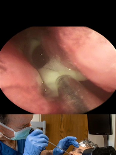 Clearing sinuses with endoscopic suction therapy #clearingsinuses #sinuses #suction #sinusrelief #endoscopy