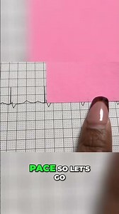 How to Read EKGs (Pacemaker) #nursing cardiacmonitoring #nursingstudent #monitortech #pacemaker