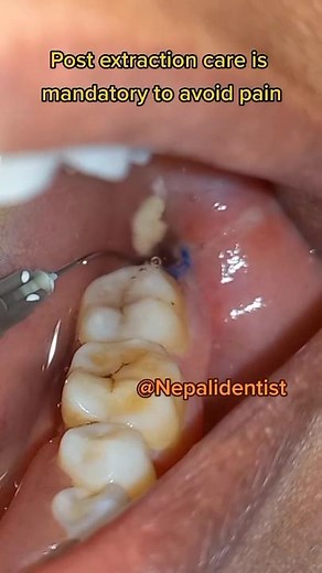 Post extraction care prevents socket infection and pain #Nepali #dentist #drbiplob #lifeofadentist #stayaware #premierdentalnepal #oralhealth #awareness